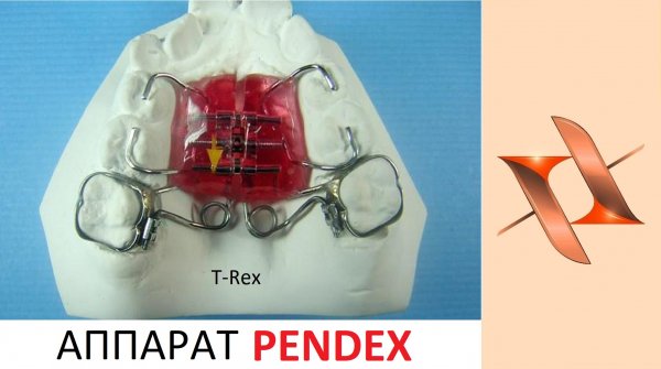Ортодонтический аппарат Pendex.