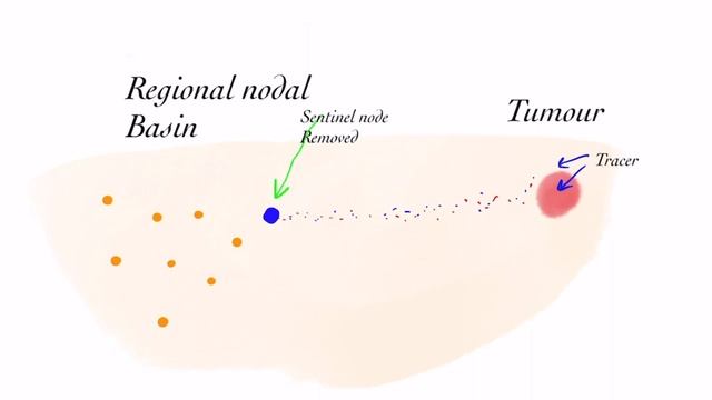 Sentinel node biopsy - How it works смотреть онлайн