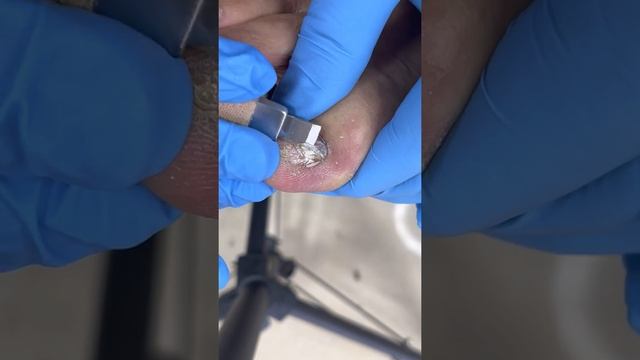 Black And Thick Toenails【Pedicure Master Lin Jun】