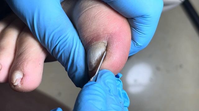 Pedicure for seniors, thick nails【Foot Scalpel】 смотреть онлайн