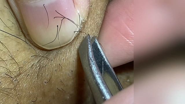 Pili Multigemini Treatment | Compilation #1