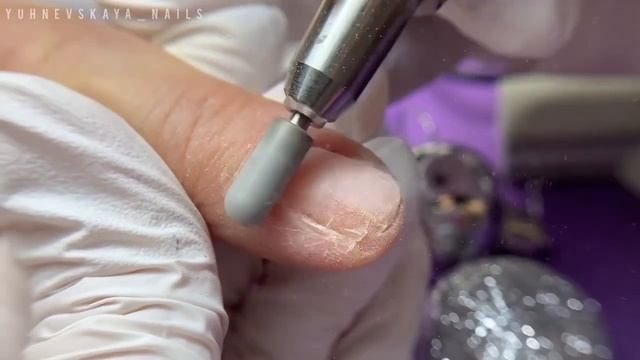 Онихолизис как следствие травматизации ногтя. Протезирование и дизайн #покрытие #гельлак #онихолизи смотреть онлайн