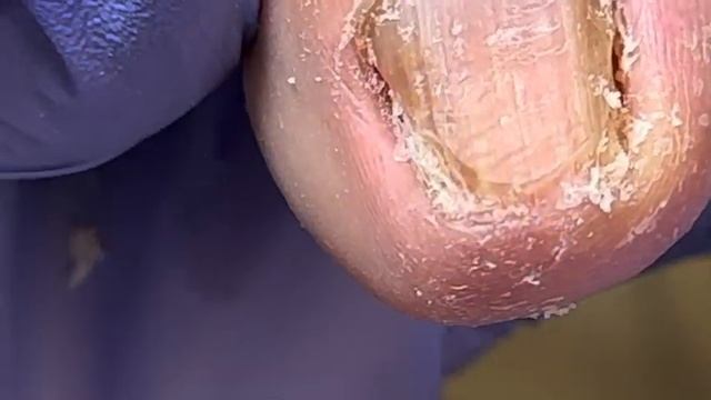 Dig out a large ingrown nail, thick and hard onychomycosis【Doctor Liu Pedicure】 смотреть онлайн