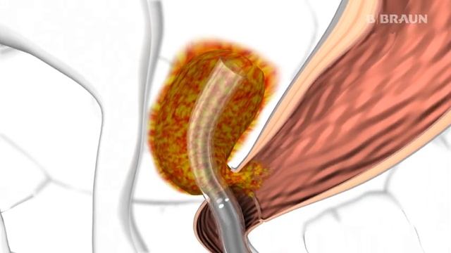 How to use Endo-SPONGE® смотреть онлайн