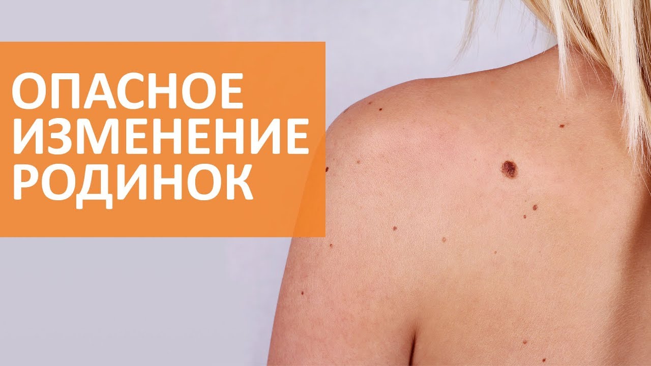 Признаки опасных изменений родинки ¦ Дерматолог клиники Семейный доктор смотреть онлайн