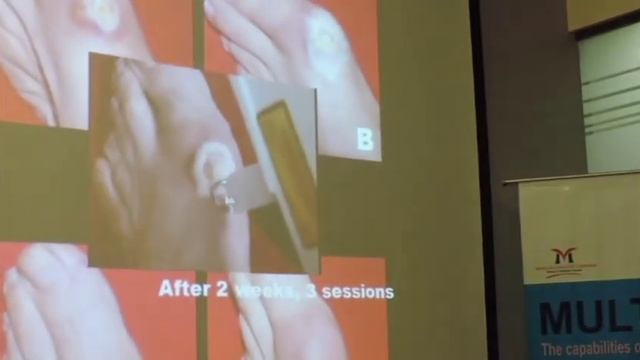 Wound healing using RecoSMA™ explained by Dr Mario Trellis смотреть онлайн