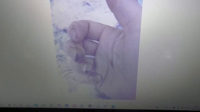 Отмороженные пальцы на руках. Как произошло? Что делать? Последствия. смотреть онлайн