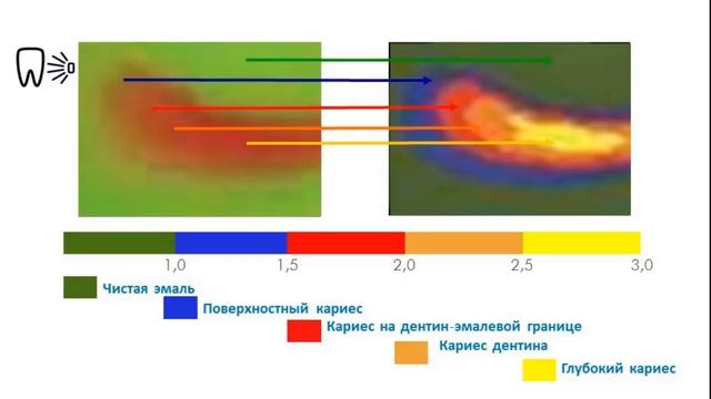 VistaCam IX интраоральная видеокамера Обзор смотреть онлайн