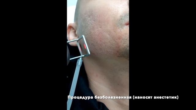 Постакне: выравнивание кожи лазером смотреть онлайн