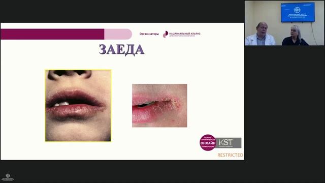 2020. Семинар: "Аллергодерматозы как междисциплинарная проблема" смотреть онлайн