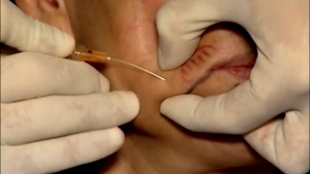 8 point lift with Juvederm смотреть онлайн