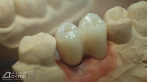 Цельнокерамические коронки из диоксида циркония