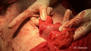 Хирургия для чайников. Межкишечный анастомоз.