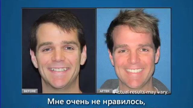 Invisalign - прозрачные брекет системы