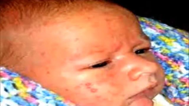 baby acne treatment - get rid of acne смотреть онлайн
