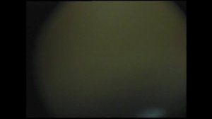 Деструкция стекловидного тела.