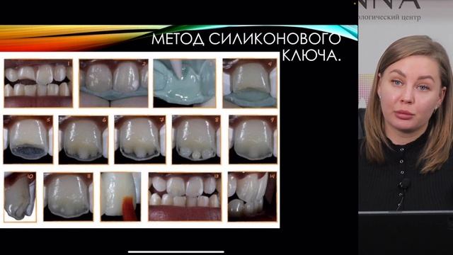 Реставрация фронтальных групп зубов в стоматологии Авиценна смотреть онлайн