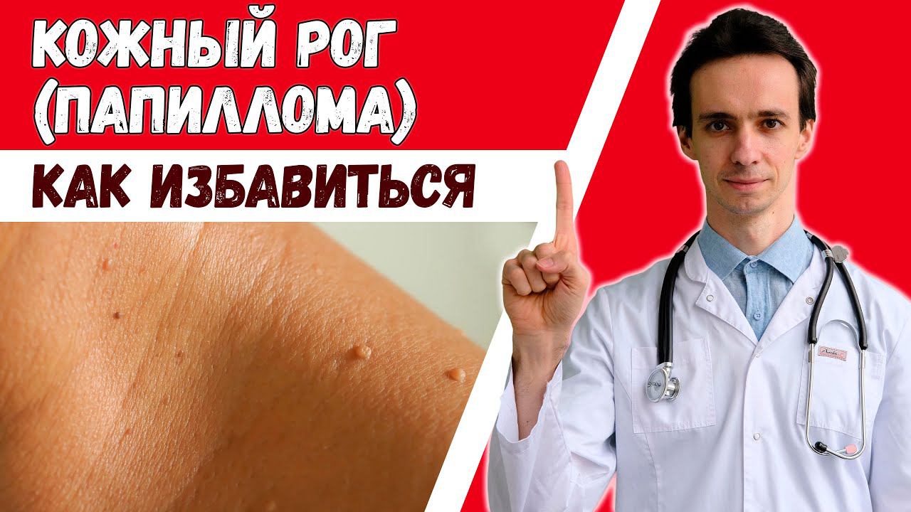 Папилломы (акрохордон, кожный рог). Откуда берутся и как избавиться? смотреть онлайн