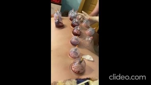 ХИДЖАМА ГИРУДОТЕРАПИЯ МАССАЖ ДЕТСКИЙ И ВЗРОСЛЫЙ В ЭНГЕЛЬСЕ. ЗВОНИТЕ: 8 987 811-41-10