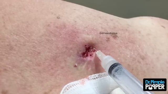 Mrs Gold's Back Blackhead Extraction Session - Addressing The Inflamed One