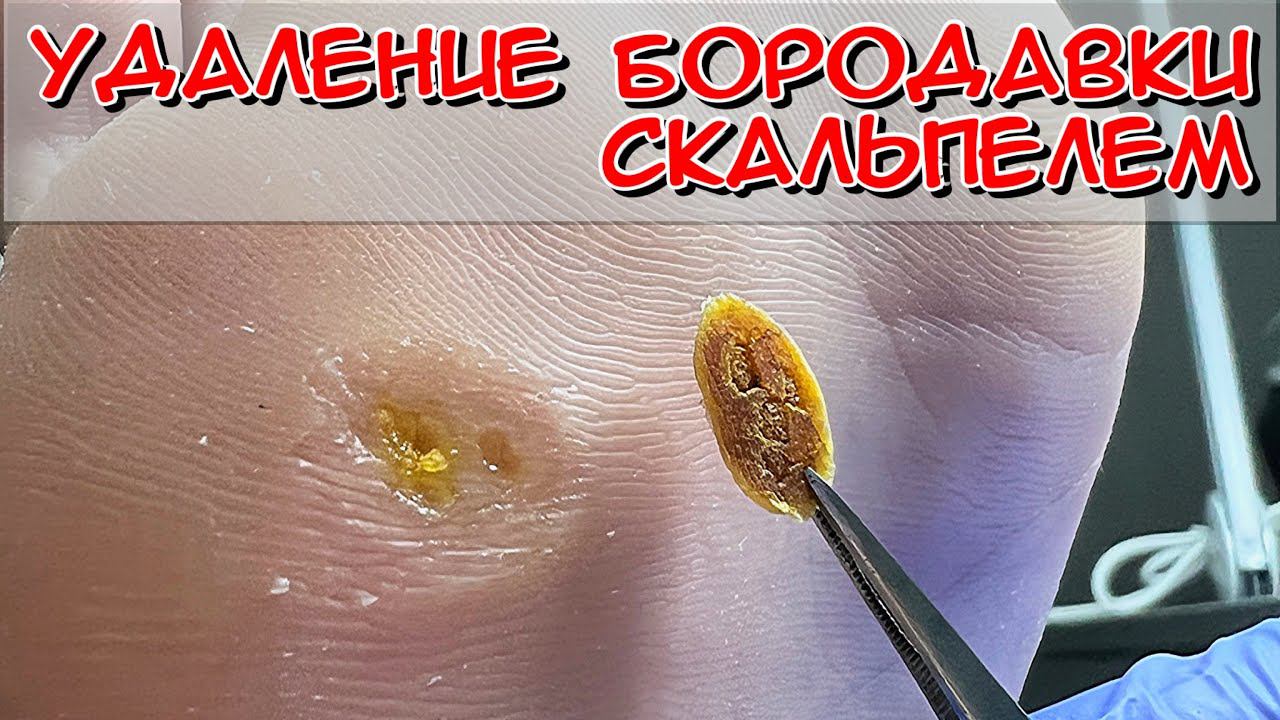 Удаление бородавки скальпелем / Бородавка на стопе / бородавки / Педикюр смотреть онлайн