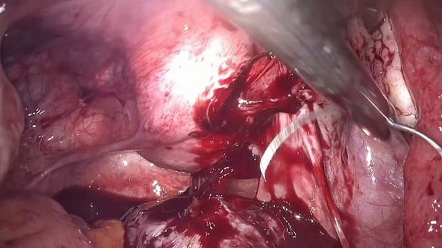 Шеечная миома. Cervical myoma. смотреть онлайн