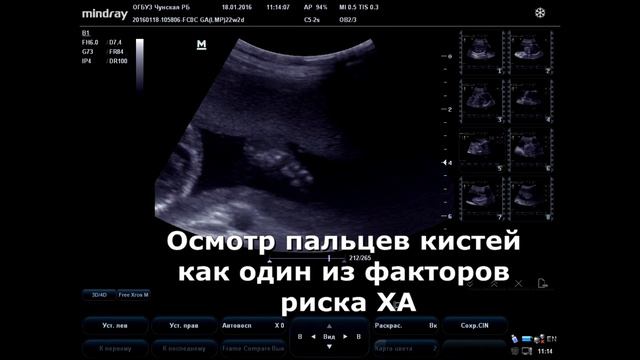 Второй скрининг при изменениях на первом смотреть онлайн