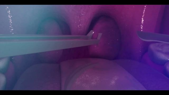 How Tonsillectomy is Performed? | Tonsils Removal Surgery смотреть онлайн