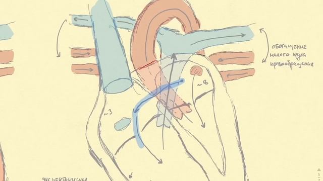 Дефект межпредсердной перегородки. Врожденные пороки сердца. смотреть онлайн