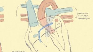 Дефект межпредсердной перегородки. Врожденные пороки сердца.