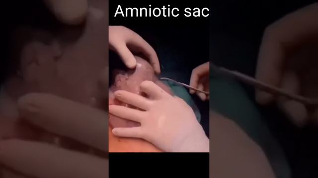 Amniotic sac (obs/gyne ward) смотреть онлайн