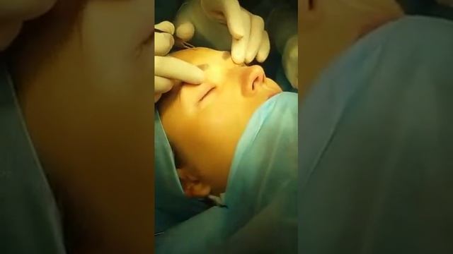 Нижняя трансконъюнктивальная блефаропластика смотреть онлайн