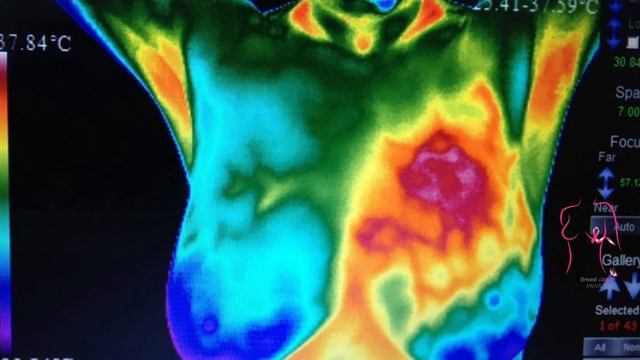 The misconception of breast cancer and its early warning signs to fibrocystic breasts. [must watch] смотреть онлайн