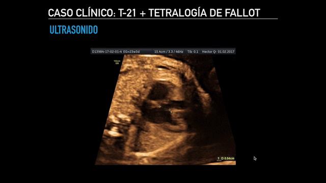 Caso Clínico: Síndrome de Down asociado de Tetralogía de Fallot смотреть онлайн
