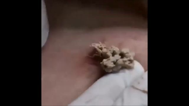 Огромный застарелый жировик смотреть онлайн