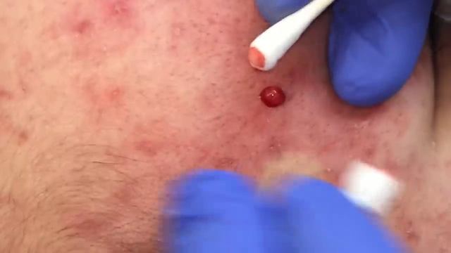 Blackhead Extractions On Leslie (Part 2)