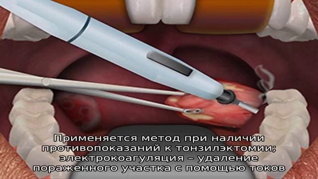 Прижигание миндалин лазером смотреть онлайн
