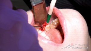 Как хирург удаляет непрорезавшийся зуб мудрости • LIFE