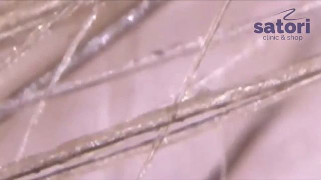 Трихоскопия – исследование волос и кожи головы смотреть онлайн