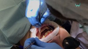 Установка брекетов Damon Q. Металлические брекеты