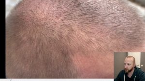 КОРОТКАЯ СТРИЖКА ПОСЛЕ ПЕРЕСАДКИ