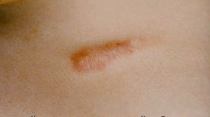 Прививка БЦЖ у новорожденных: что это такое, возможная реакция