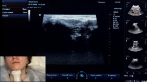 Узи для начинающих. Урок "УЗИ слюнной железы"