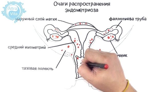 Женское бесплодие