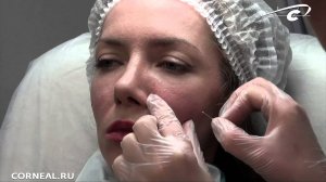 Биоревитализация, выбор канюли, техника введения