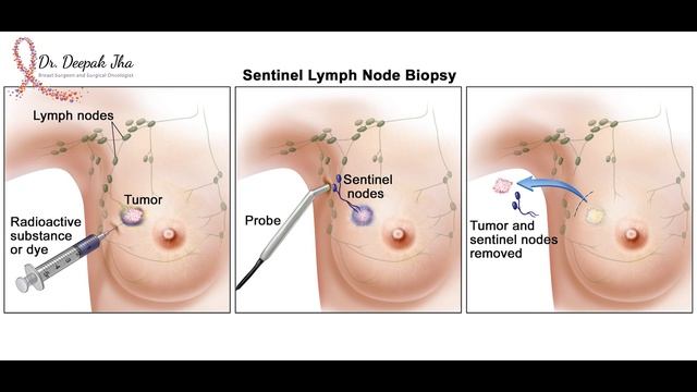 Sentinel Lymph Node Biopsy | Dr. Deepak Jha смотреть онлайн