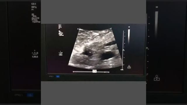 Рак головки поджелудочной железы узи смотреть онлайн