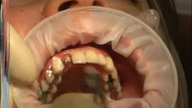 Снятие коронки