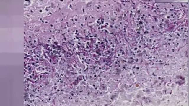 Hwp1 Candida albicans hyphae surface protein (transglutaminase substrate) смотреть онлайн