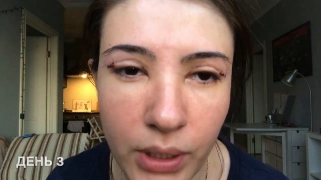 Блефаропластика мой результат! смотреть онлайн